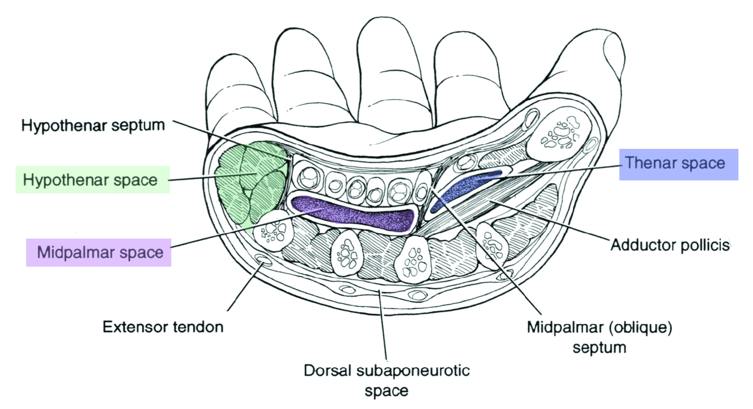 Deep Space & Collar Button Infections Hand Orthobullets